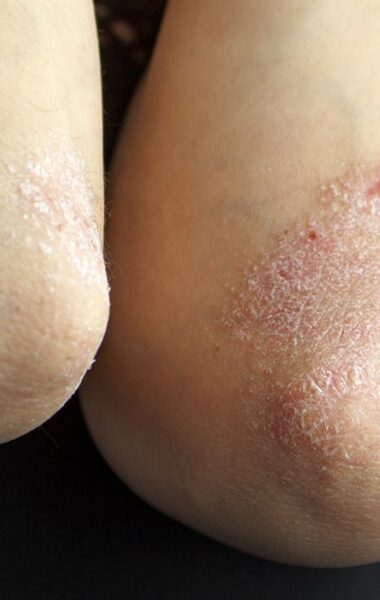 Sfaturi pentru a preveni pielea uscată
