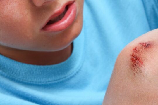 Prevenirea formării cicatricilor în urma leziunilor abrazive