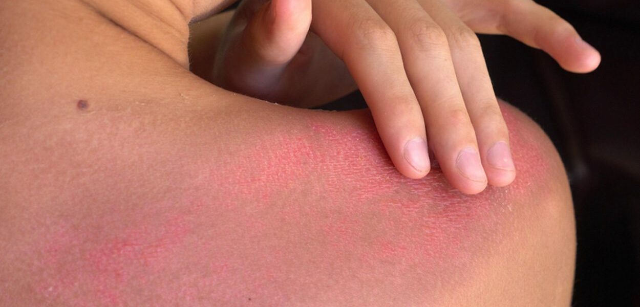 Sfaturi pentru îngrijirea pielii arse de soare
