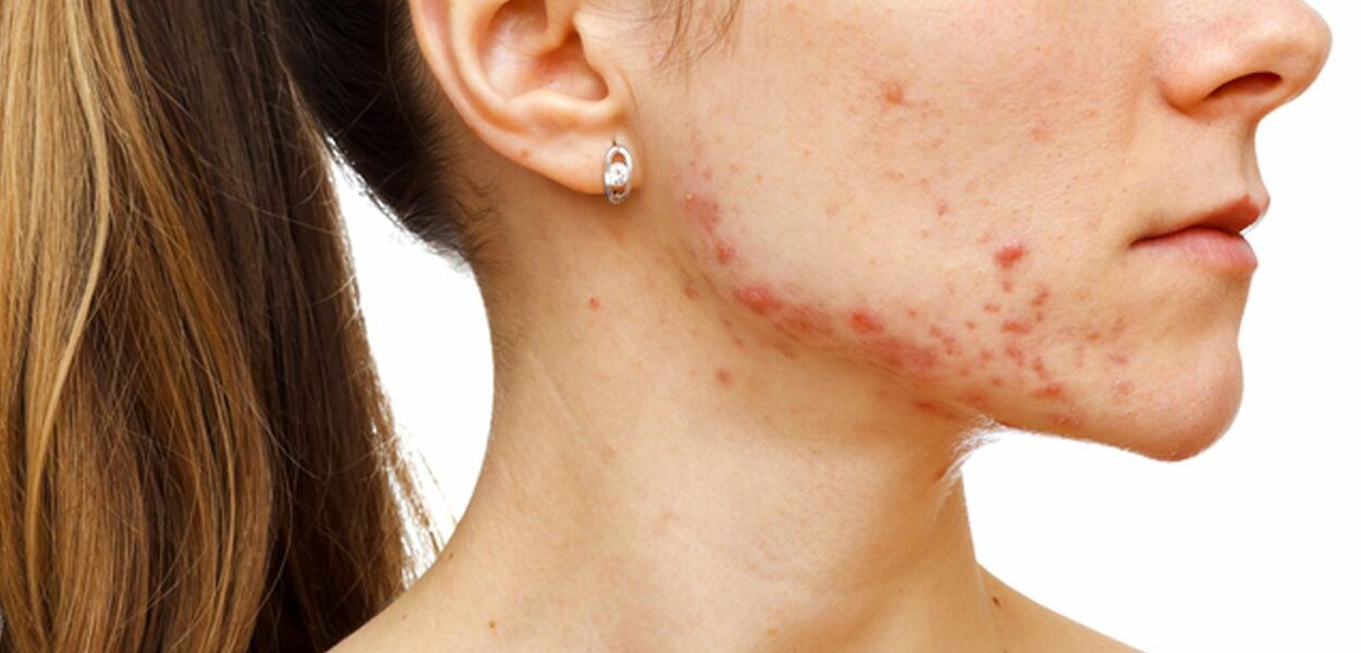 Elimină cicatricile provocate de acnee: sfaturi practice pentru un tratament la domiciliu