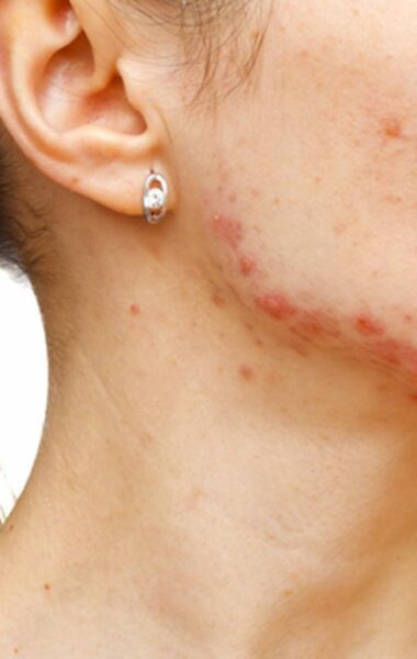 Elimină cicatricile provocate de acnee: sfaturi practice pentru un tratament la domiciliu